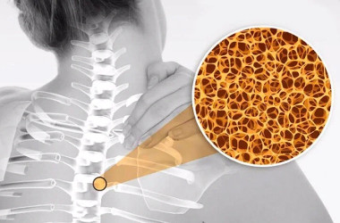 Остеопороз: 4 способа предотвращения данного заболевания костей